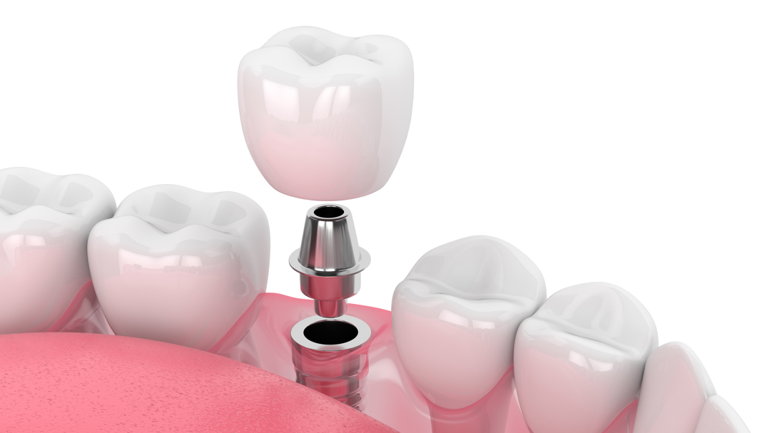 Aspen Dental Implants