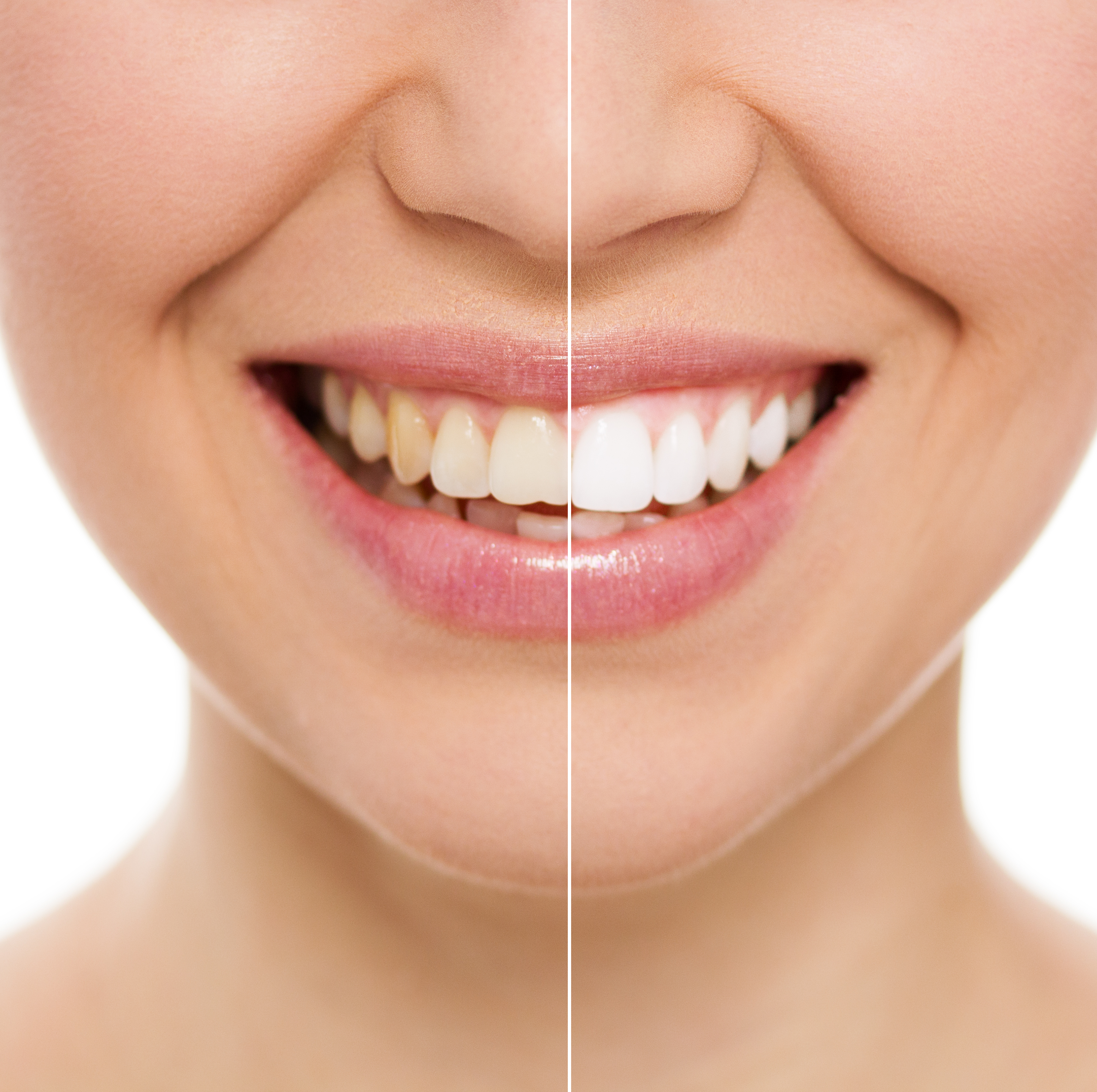 Teeth Whitening in Aspen, CO