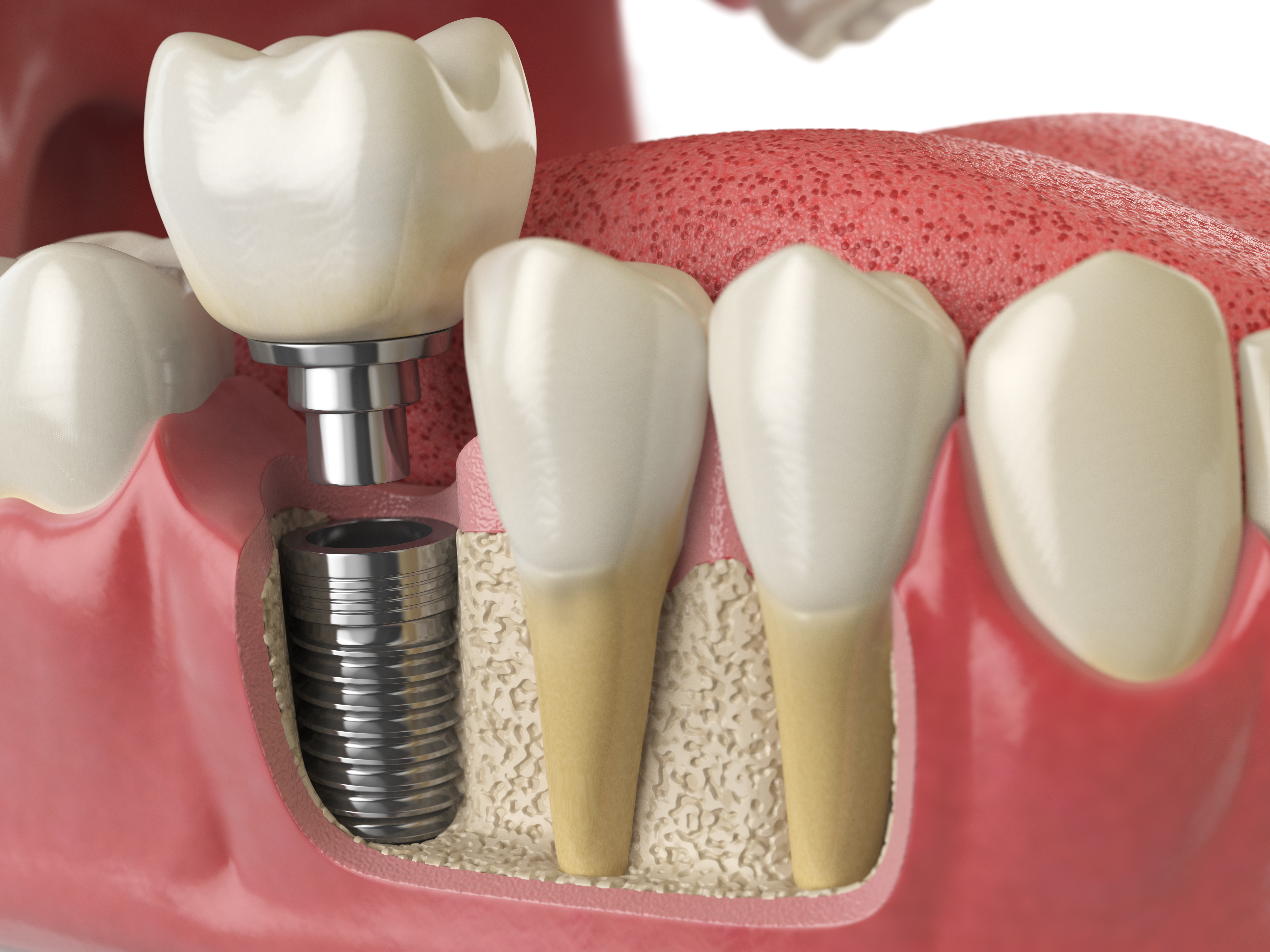dental implant picture