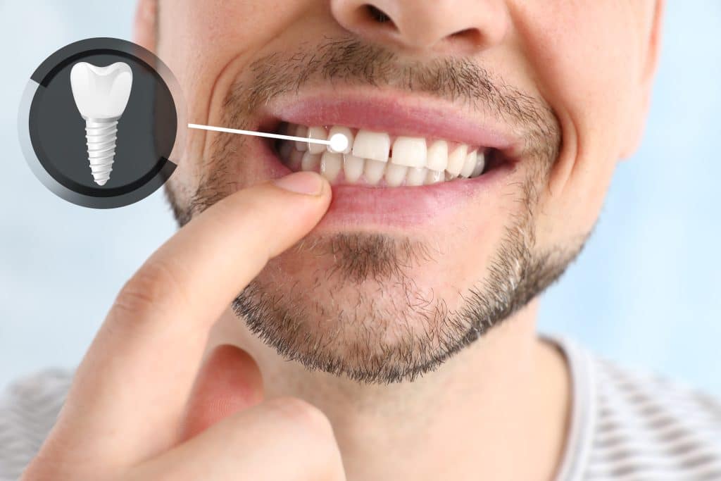 Dental Implants in Aspen